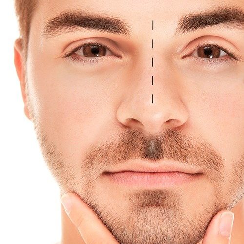 RINOPLASTIA MASCULINA